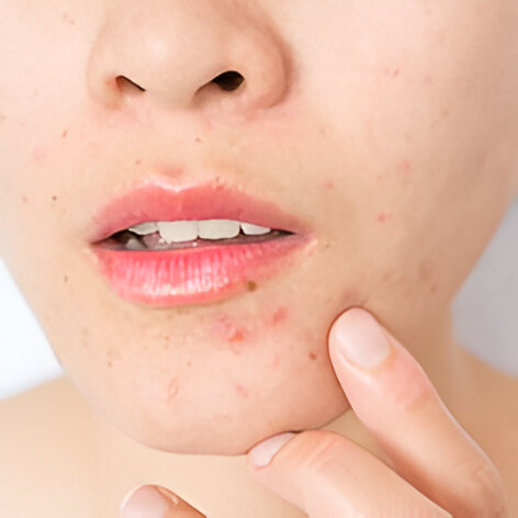 Acne na Fase Adulta: E agora?